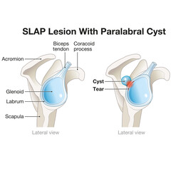 SLAP lesion paralabral cyst in the shoulder. Medically Illustration. Labeled