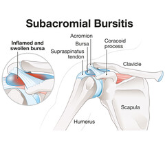 Subacromial bursitis of the shoulder. Medically Illustration. Labeled - obrazy, fototapety, plakaty