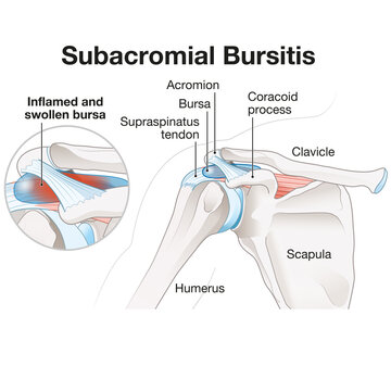 Subacromial bursitis of the shoulder. Medically Illustration. Labeled