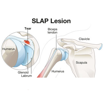 SLAP Lesion Of The Shoulder. Medically illustration. Labeled