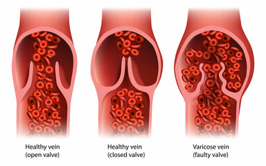 Chronic Venous Insufficiency or venous reflux.Venous Disease Varicose vein Faulty valve. Healthy vein - obrazy, fototapety, plakaty