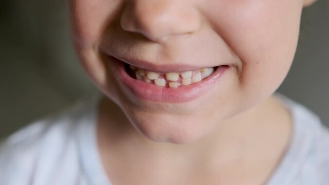 Close up shot of baby's tooth is ready to fall out. 