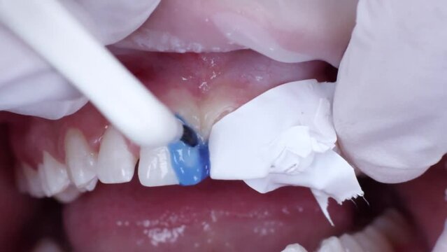 dentist apply acid itch blue gel on mesial aspect of central incisors teeth during diastema closure dental procedure, close up