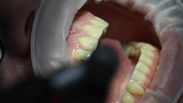 Dental Extreme Close up Macro Video. Dentist treat patient teeth. Dental internist works with an assistant use cofferdam. Concept of professional dental hygiene. 4k 120 fps slow motion raw footage