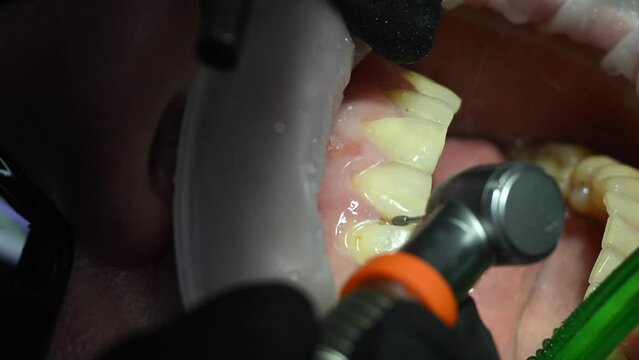 Dental Extreme Close up Macro Video. Dentist treat patient teeth. Dental internist works with an assistant use cofferdam. Concept of professional dental hygiene. 4k 120 fps slow motion raw footage
