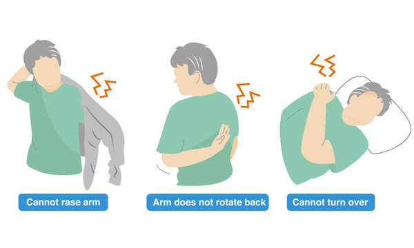Illustration of a person with a sore shoulder and an arm that cannot lift.Impingement Syndrome