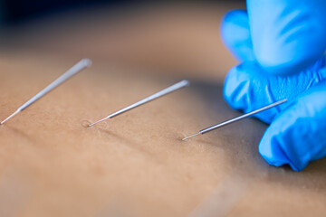 Close up of a needle and hands of physiotherapist doing a dry needling.