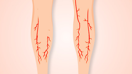 Concept of vascular disease, varicose veins, and venous insufficiency.