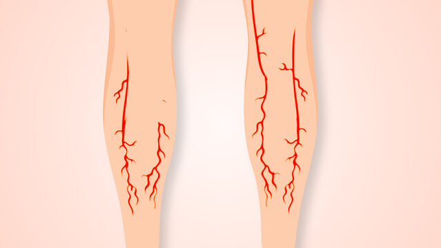 Concept of vascular disease, varicose veins, and venous insufficiency.