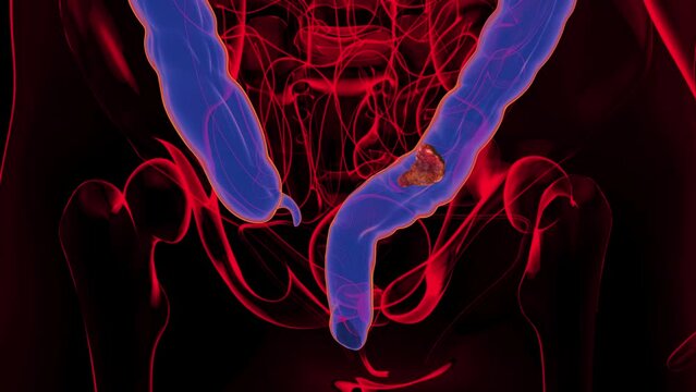 4K abstract animation of the colon cancer