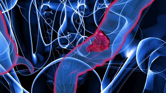 4K abstract animation of the colon cancer