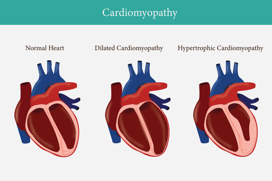 Types of heart diseases: hypertrophic cardiomyopathy and dilated cardiomyopathy. healthy heart and heart with Pathology. illustration for medical use. eps 10