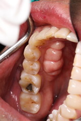 Torus mandibularis is a bony growth in the mandible along the surface nearest to the tongue....