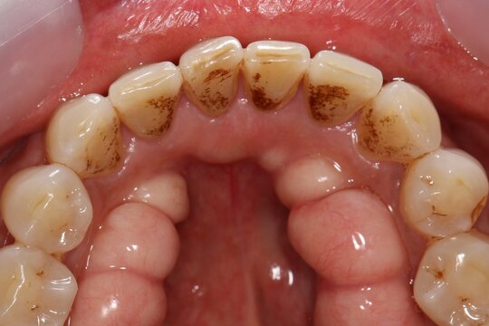 Torus mandibularis is a bony growth in the mandible along the surface nearest to the tongue. Mandibular tori are usually present near the premolars and above the location of the mylohyoid muscle.