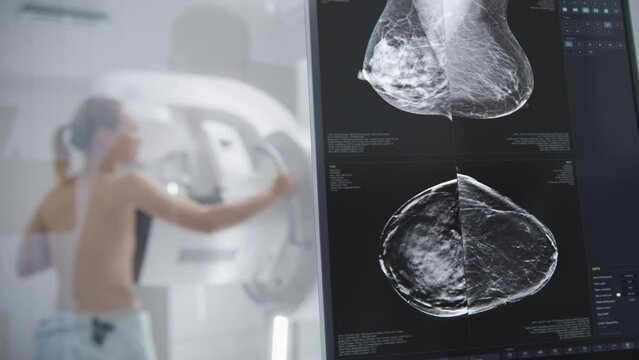 Computer control panel screen for mammogram scans imaging. Caucasian woman stands topless during mammography screening procedure in hospital radiology room. Breast cancer prevention. Modern clinic.