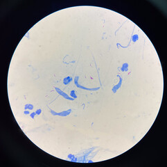 Mycobacterium tuberculosis.AFB positive 3+.