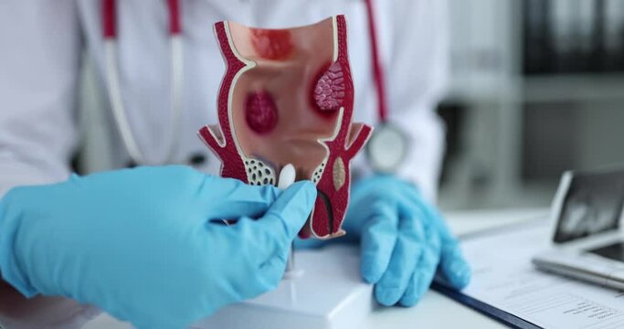 Proctologist doctor inserting rectal suppository into artificial model of human rectum closeup 4k movie slow motion. Hemorrhoid treatment concept