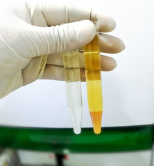 Lab Technologist hold 2 urine sample tube for analysis, one is normal stow color urine sample and...