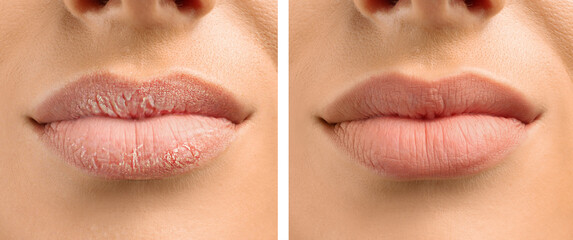 Young woman before and after treatment of dry lips, closeup - obrazy, fototapety, plakaty