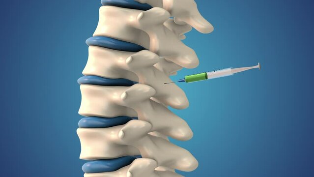 Stem cells are injected into a spine in an animation