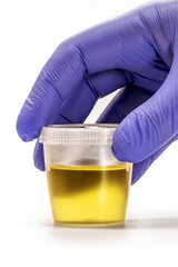 collection bottle with urine being handled by blue gloved hand, EAS urine test - Abnormal Sediment...