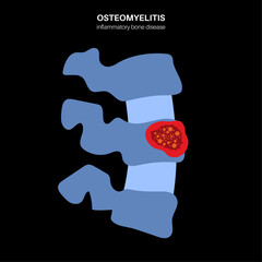 Vertebral osteomyelitis poster