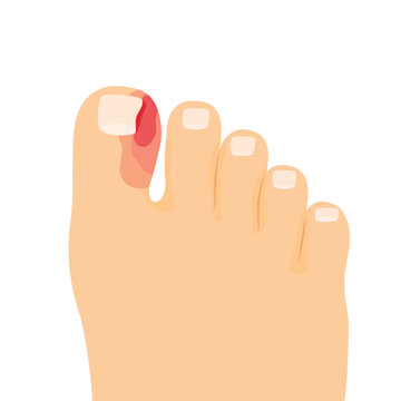 ingrown toenail, paronychia of the toe- vector illustration