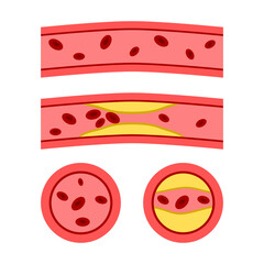 Cholesterol in vessels blood clogged arteries medical icon flat vector design