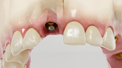 front teeth dental implant - obrazy, fototapety, plakaty