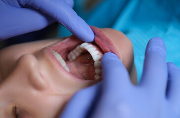Doctor dentist examining patient oral cavity with veneers closeup. Installation of composite and...