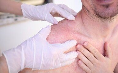 Doctor in gloves conducts initial examination of man with sunburn on skin of his shoulders and...