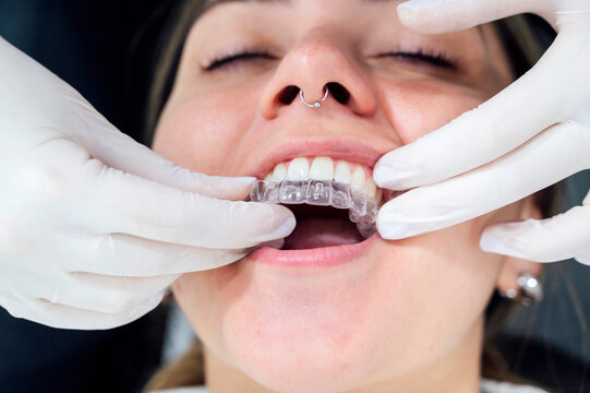 Hands of dentist inserting dental aligner to patient at clinic