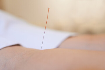 Acupuncture needle on chakra point on the back of the knee of a patient. Chinese traditional...
