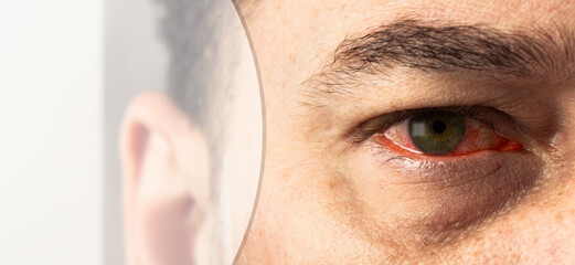 Red eye in a person. A close-up of a heavily bloodshot eye. Ophthalmia. Conjunctivitis. Copy space
