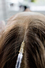 Close-up shot of plasma injections anti hair loss procedure. Young female patient prp procedure for hair regrowth