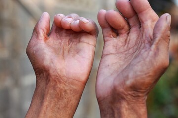 Asian old man's hand is injured by exposure to hot water