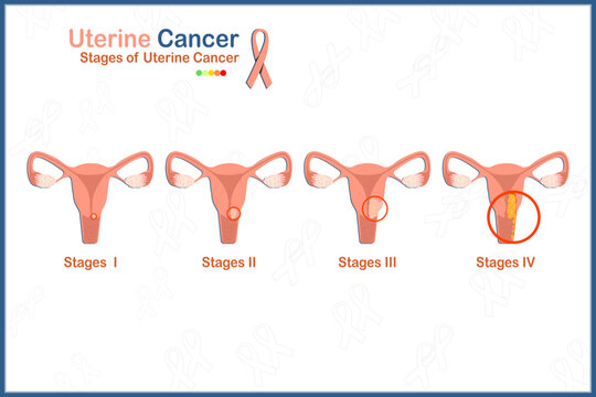 Flat medical vector illustration concept of 4 stages of uterine cancer on white background.