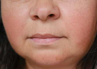 close up part face mature woman 55 years old, lower half of face, double chin, deep wrinkles around mouth, sagging cheeks, aesthetic injection cosmetology, correction surgery, antiaging procedures