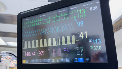 Medical monitor displays vital signs with graphs and numbers, heart rate, blood pressure,...
