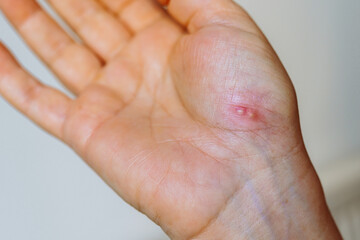 herpes on palm woman's hand