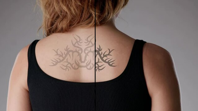 Laser Tattoo Removal On Woman's Back