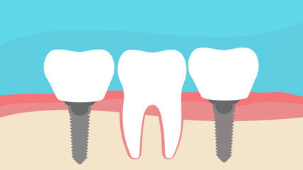 dental implant, A vector flat stock illustration