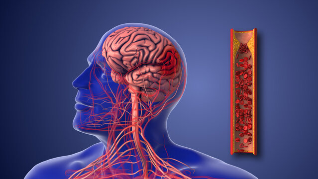ischemic stroke or cerebrovascular disease from atherosclerotic stenosis