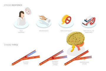 3D Isometric Flat  Conceptual Illustration of Brain Blood Supply Problem, Ischemic Stroke Attack