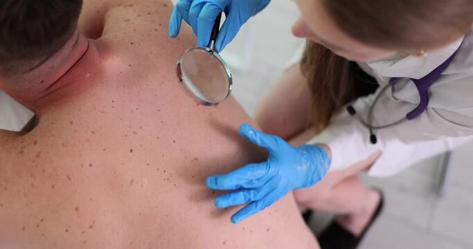 Dermatologist looking at moles on man back through magnifying glass. Man back with many moles on skin