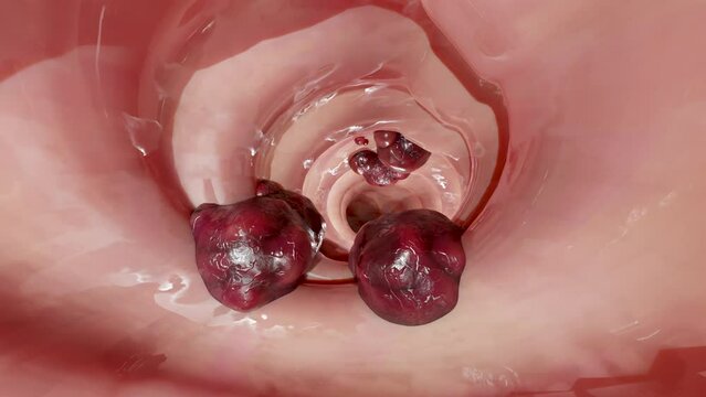 Bowel cancer or Colorectal tumor, Colon cancer, intestine inflammatory bowel Disease, intestine pain, celiac, infections, duplicating, cells expanding, malignant cancerous, viruses, 3d render