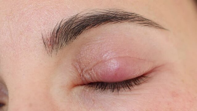 Close up female patient's infected eye. The brown-eyed woman staring at the camera has an external stye bacterial infection. Hordeolum on upper eyelid. Viral Infection. Staphylococcus. Ophthalmology
