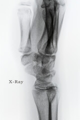 x ray image of knee bone human