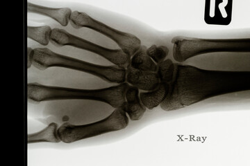x ray image of a hand