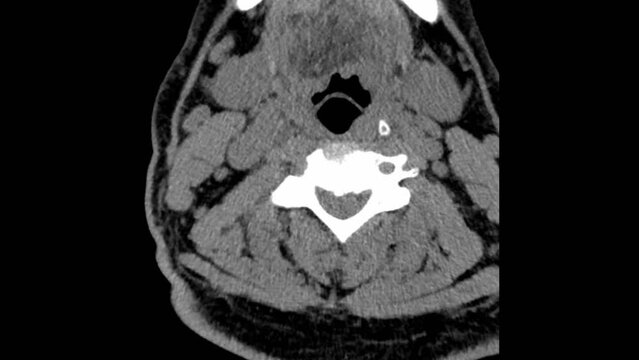 Real Tomography Diagnostic of patient with osteoporosis, pain in the spine. Magnetic Resonance Imaging MRI scanner Radiology. Computed x-Ray Medical Imaging